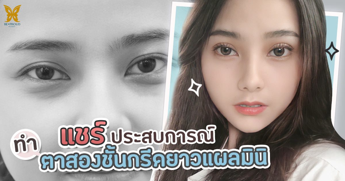 ตาสองชั้นแผลมินิ ตาสองชั้นแผลมินิ