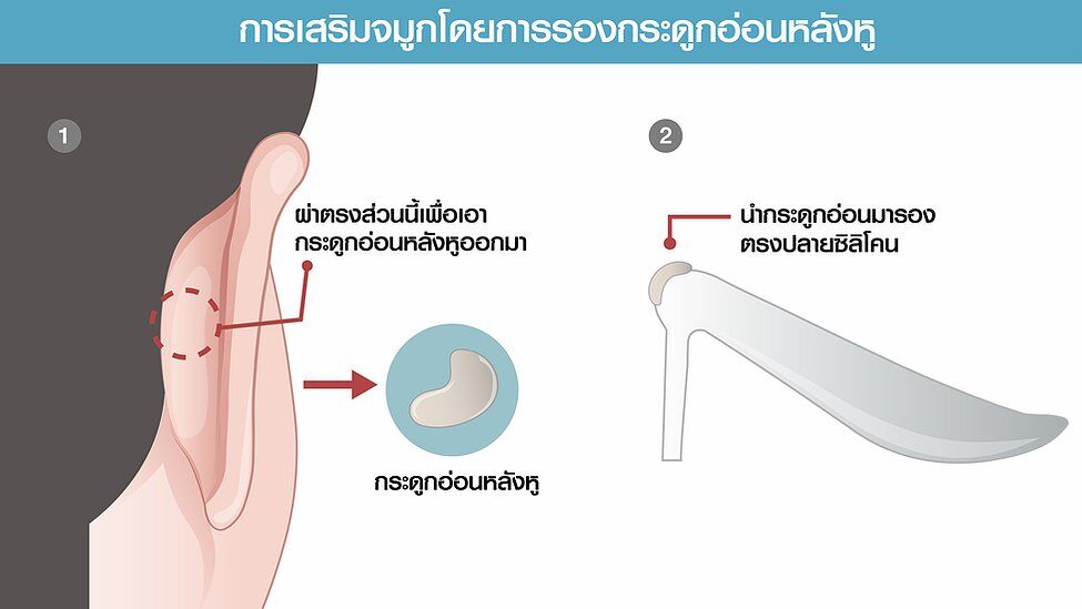 เสริมจมูก