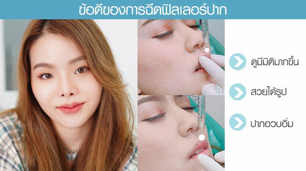 ข้อดีฟิลปาก ฟิลเลอร์ปาก