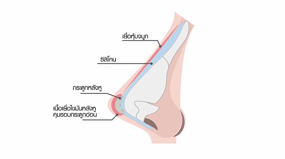 เสริมจมูก