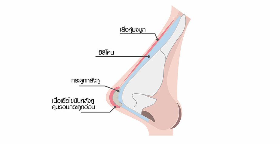 จมูกหลังหู3-01 เสริมจมูก