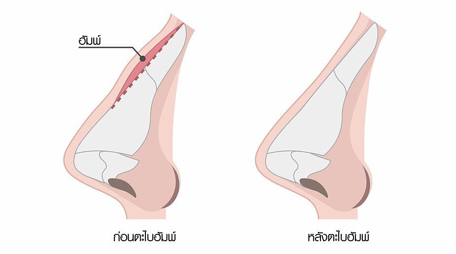 ฮัมพ์-01 เสริมจมูก
