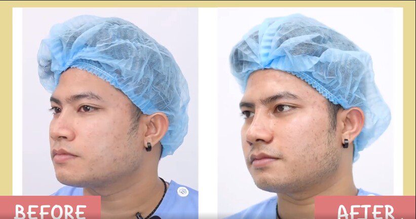 1607674608100 เสริมจมูก