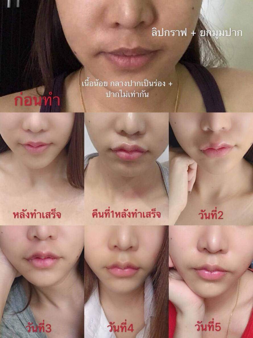 708954 ปากกระจับ