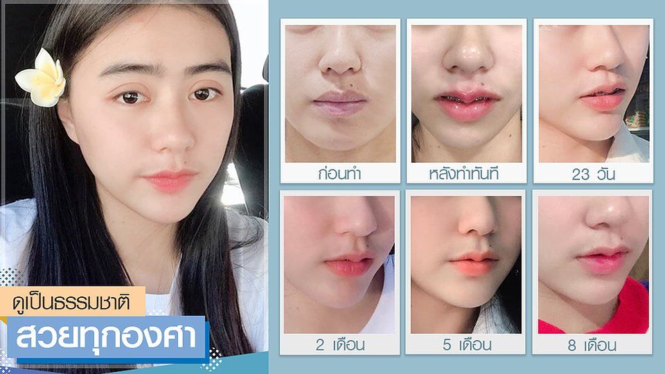 เสริมคาง
