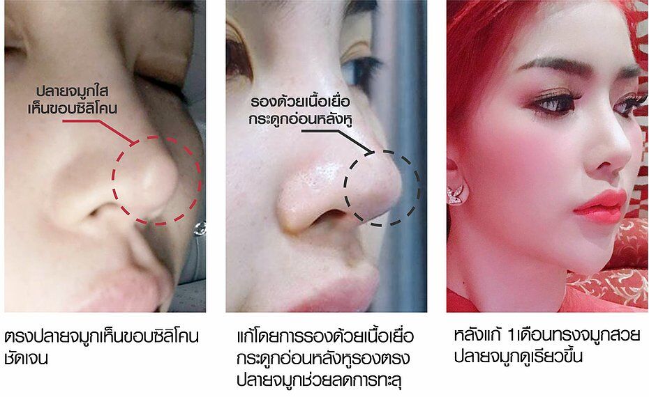 เสริมจมูก