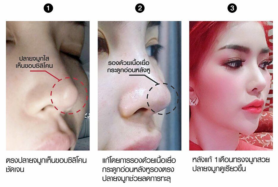 f7159c_47142df71e9e4d91b30485eb2b7f301c_mv2 เสริมจมูก