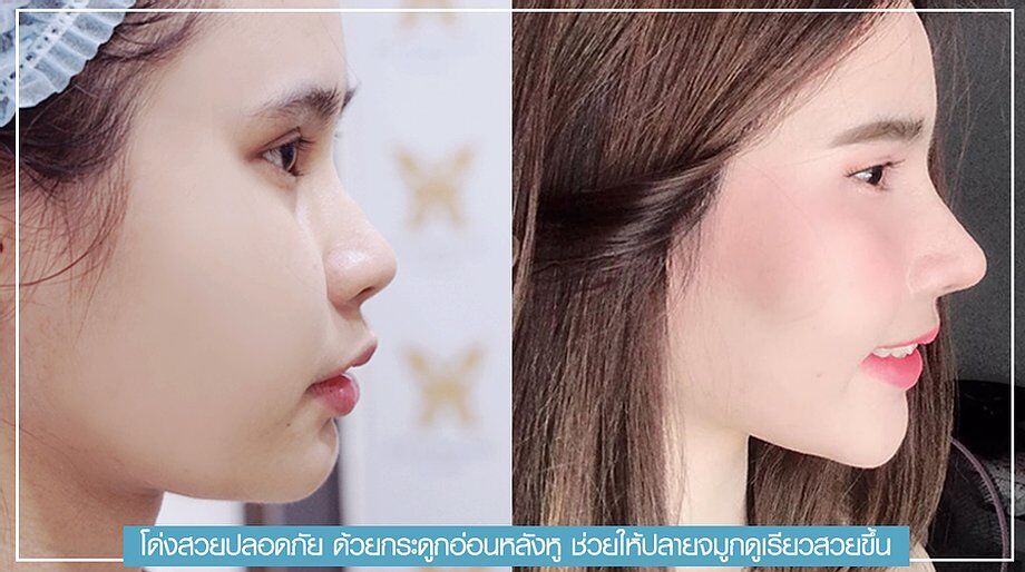 เสริมจมูก