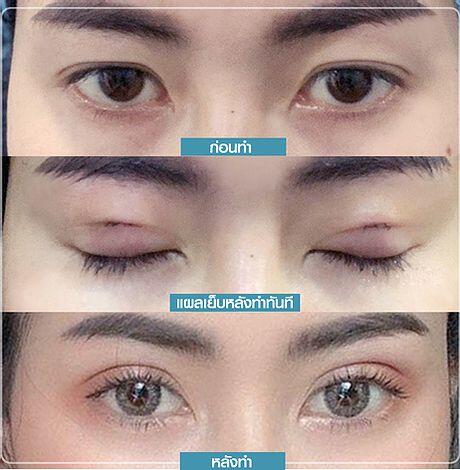 f7159c_79bf699f545040ccb6e5da2647b25f8f_mv2 ตาสองชั้น รีวิวตาสองชั้น