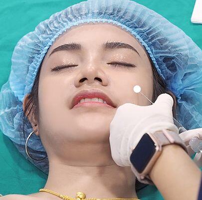 f7159c_d9a8597c6b854e9591a3d1bd0b33f95e_mv2 ฟิลเลอร์ปาก