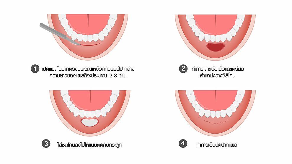 f7159c_dc712d67d57244c0a3abf9fba60614be_mv2 การทำคางแผลใน