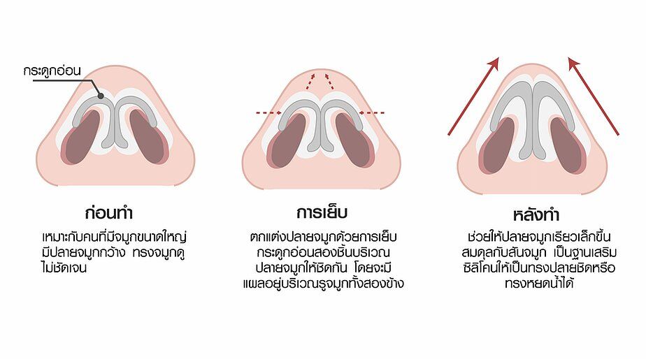 f7159c_e69ad88120d048c8aa6173d2277c9ccf_mv2 เสริมจมูก