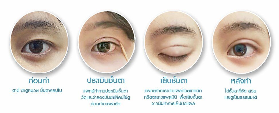 f7159c_f4c3dda15bdc42309d1c19a3e6eefff1_mv2 ตาสองชั้น รีวิวตาสองชั้น