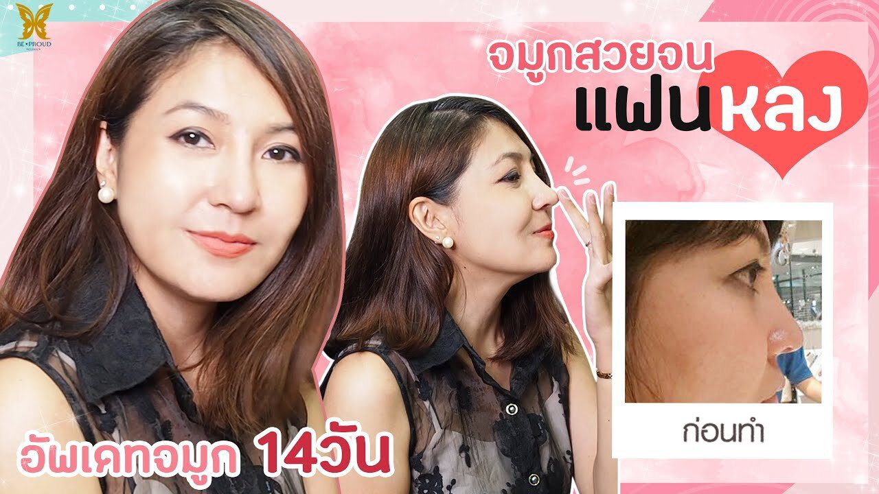 แก้จมูก เสริมจมูก เสริมจมูก