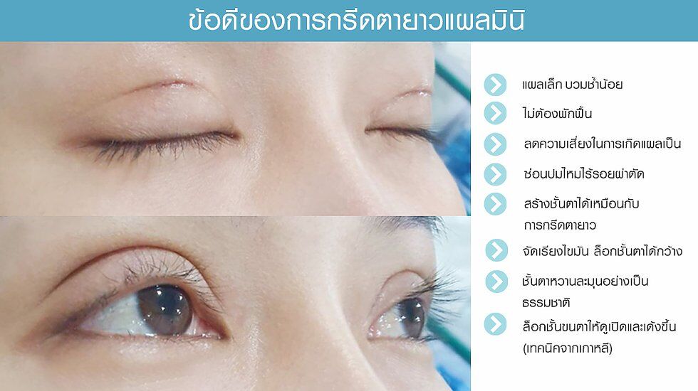 ข้แดีของการกรีดยาวมินิ