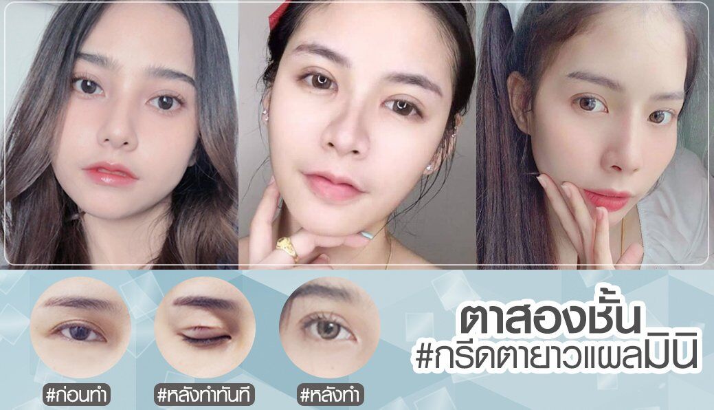 ปกตาสองชั้นมินิ2 ตาสองชั้น รีวิวตาสองชั้น