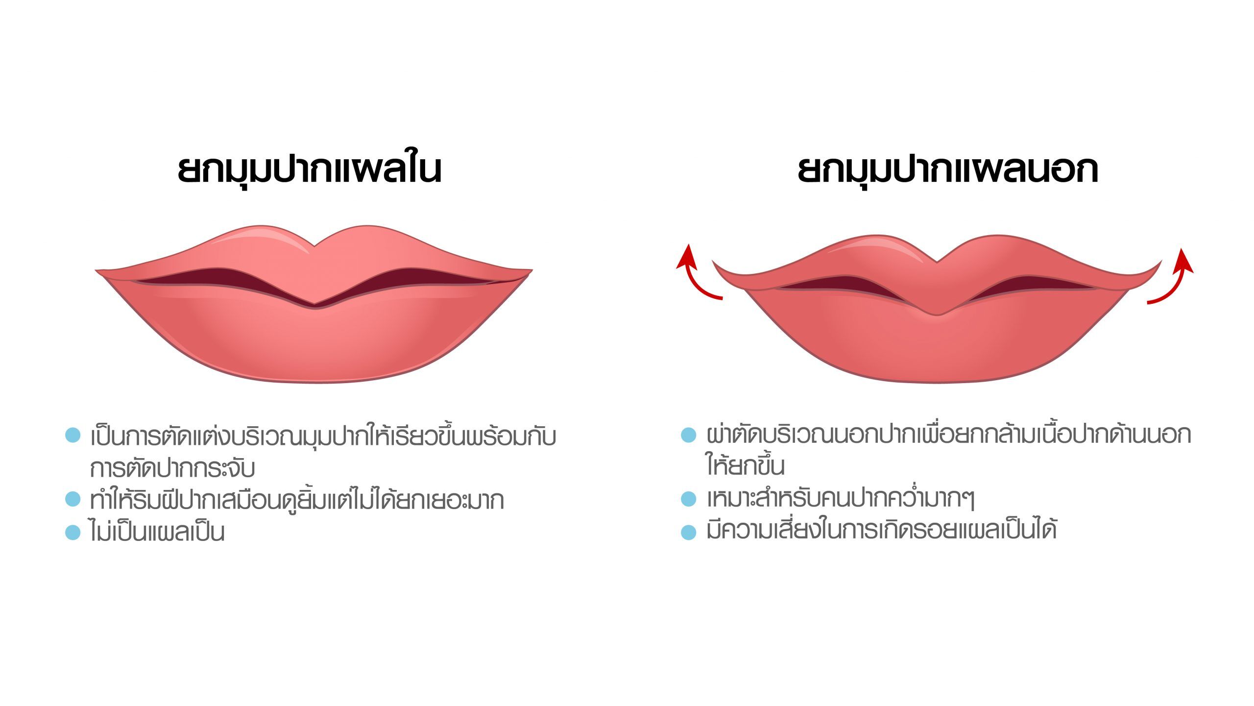 ยกมุมปาก-01 ยกมุมปากแผลใน ยกมุมปากแผลนอก