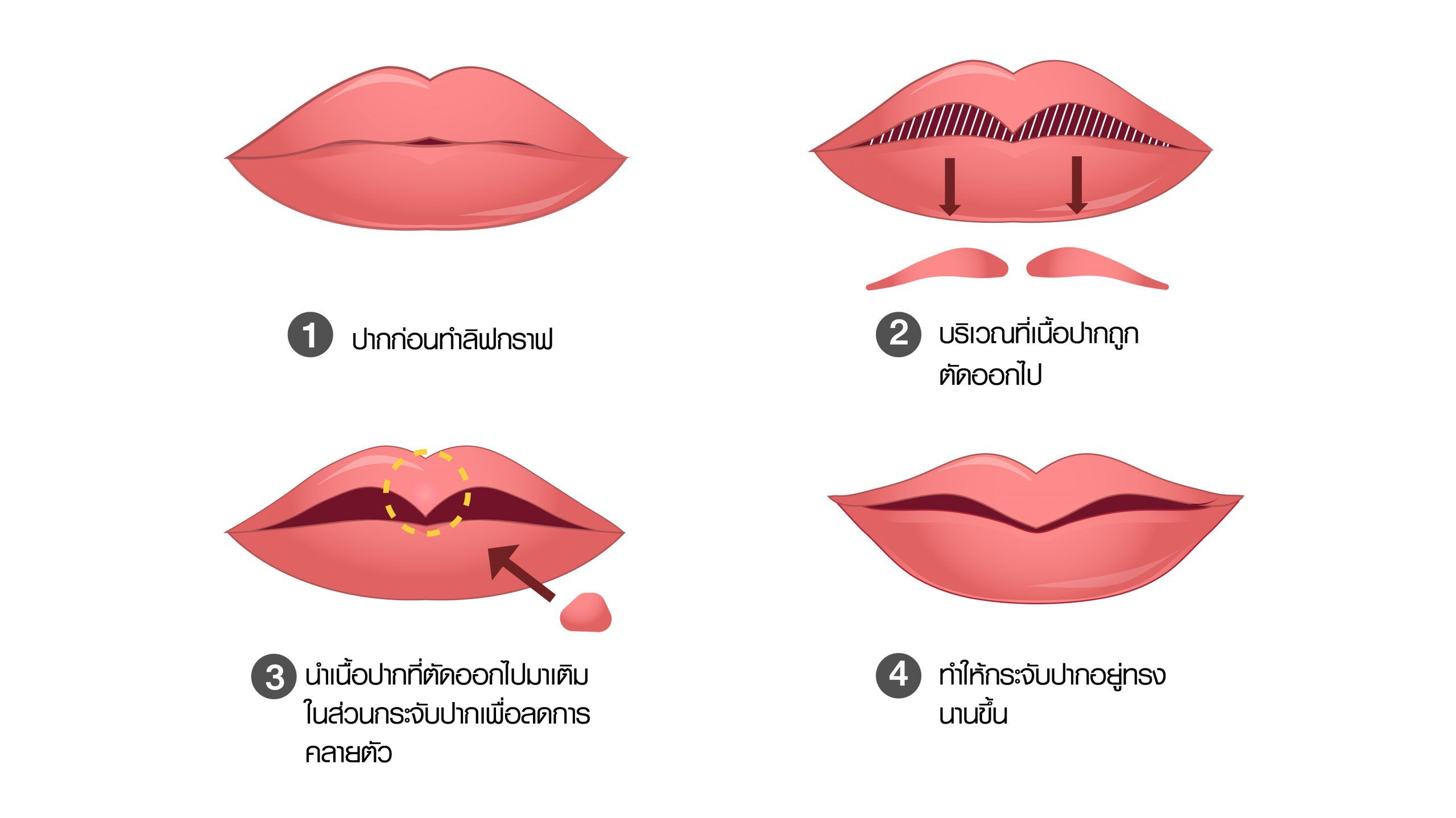 การตัดแต่งเนื้อปาก