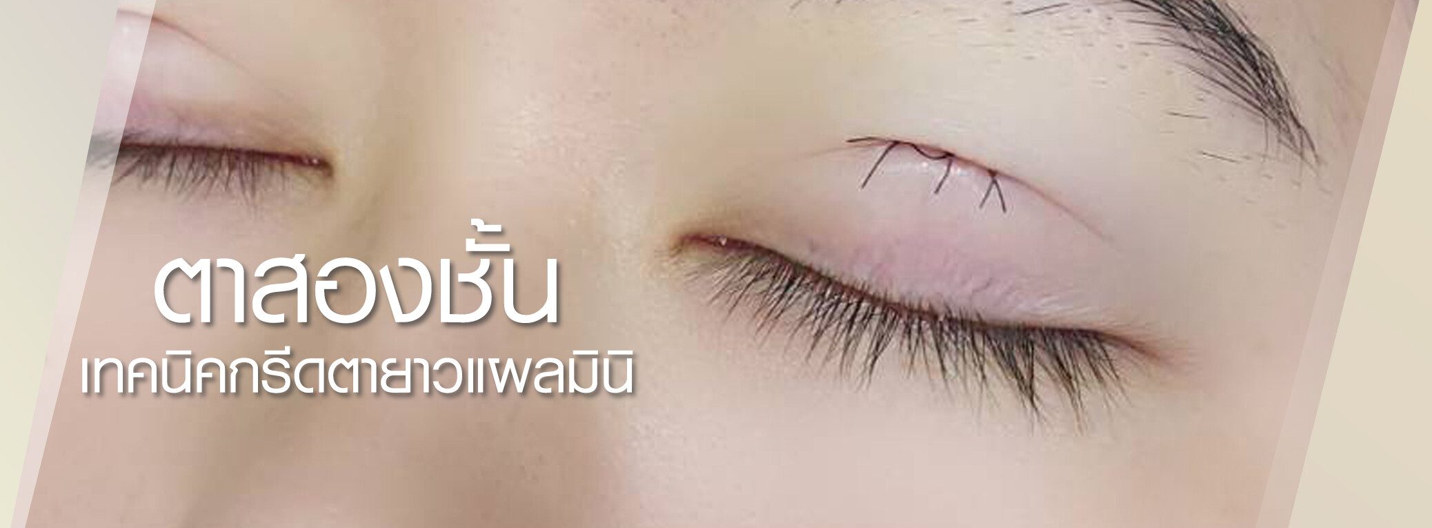 ตาสองชั้นแผลมินิ