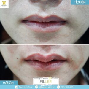 รีวิวฟิลเลอร์18