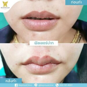 รีวิวฟิลเลอร์16