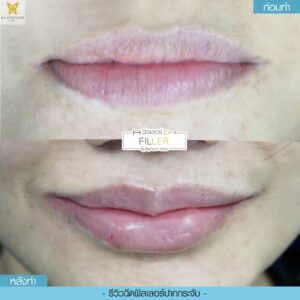 รีวิวฟิลเลอร์15