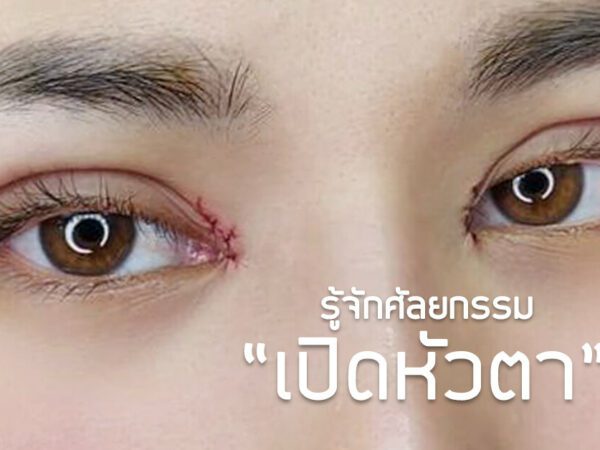 ตาสองชั้นเปิดหัวตา เปิดหัวตา