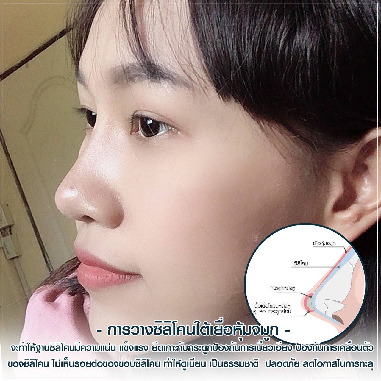 1000313 จมูกติดเชื้อ เสริมจมูก หลังทำศัลยกรรมเสริมจมูก