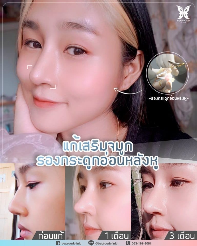 124350394_1466147296907875_2626511130767909365_n จมูกติดเชื้อ เสริมจมูก หลังทำศัลยกรรมเสริมจมูก