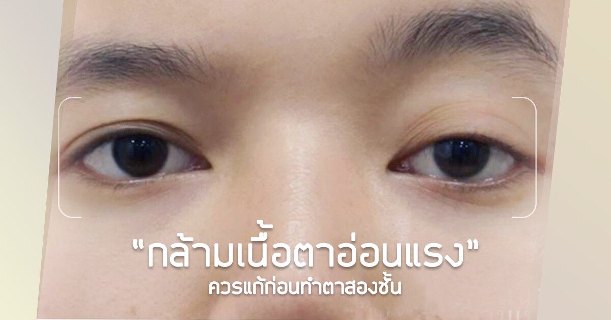กล้ามเนื้อตาอ่อนแรง กล้ามเนื้อตาอ่อนแรง