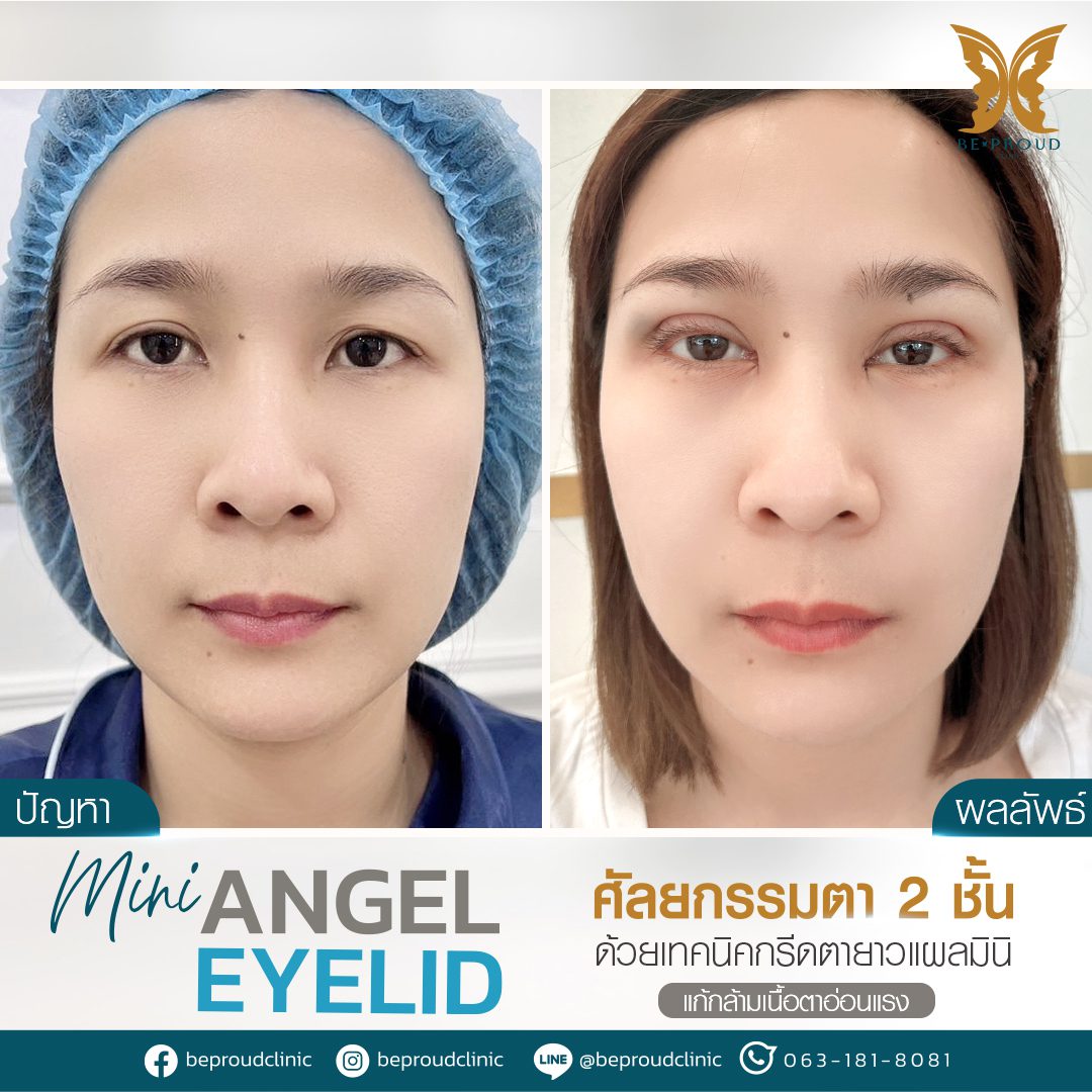 รีวิวกล้ามเนื้อตาอ่อนแรง(7) รีวิวกล้ามเนื้อตาอ่อนแรง(7)