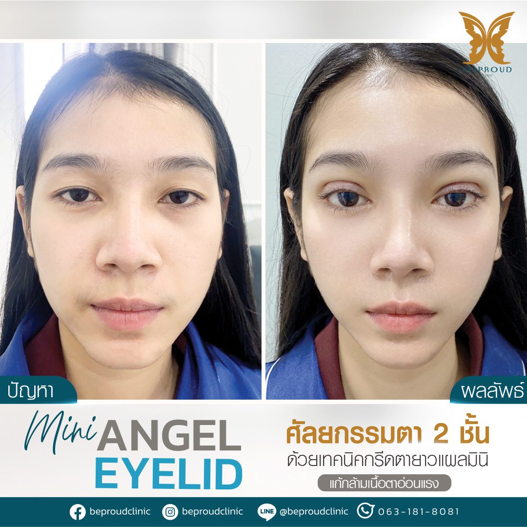รีวิวกล้ามเนื้อตาอ่อนแรง(3) รีวิวกล้ามเนื้อตาอ่อนแรง(3)