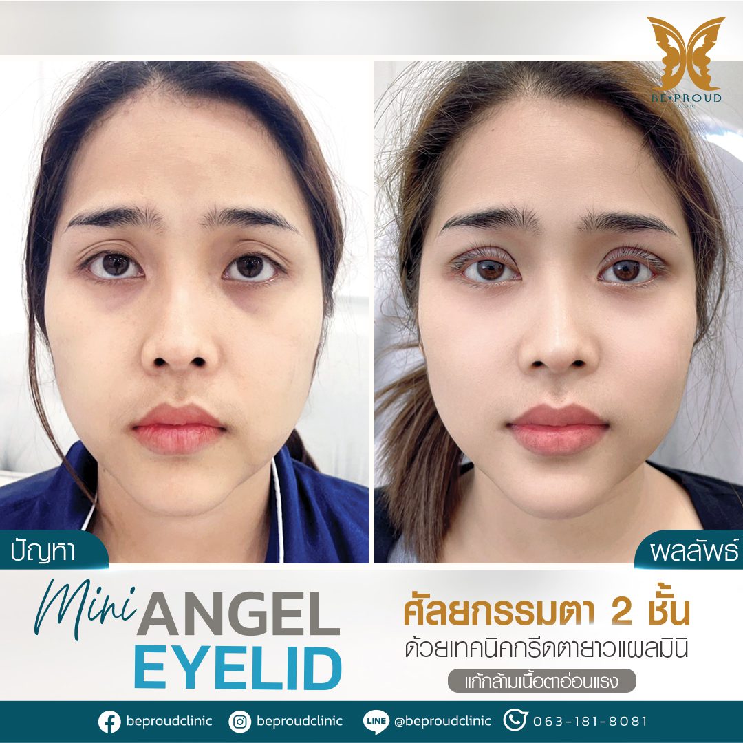 รีวิวกล้ามเนื้อตาอ่อนแรง(4) รีวิวกล้ามเนื้อตาอ่อนแรง(4)