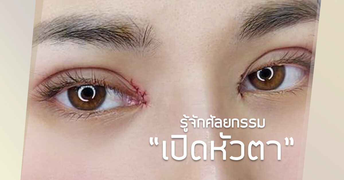 ตาสองชั้นเปิดหัวตา เปิดหัวตา ตาสองชั้นเปิดหัวตา เปิดหัวตา
