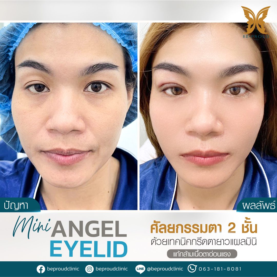 รีวิวกล้ามเนื้อตาอ่อนแรง(6) รีวิวกล้ามเนื้อตาอ่อนแรง(6)