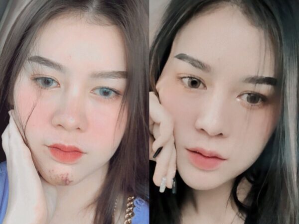 บีพราวด์คลินิก ความรู้ศัลยกรรม