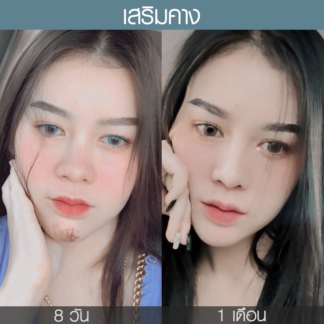 ระยะเวลาเข้าที่หลังทำศัลยกรรม