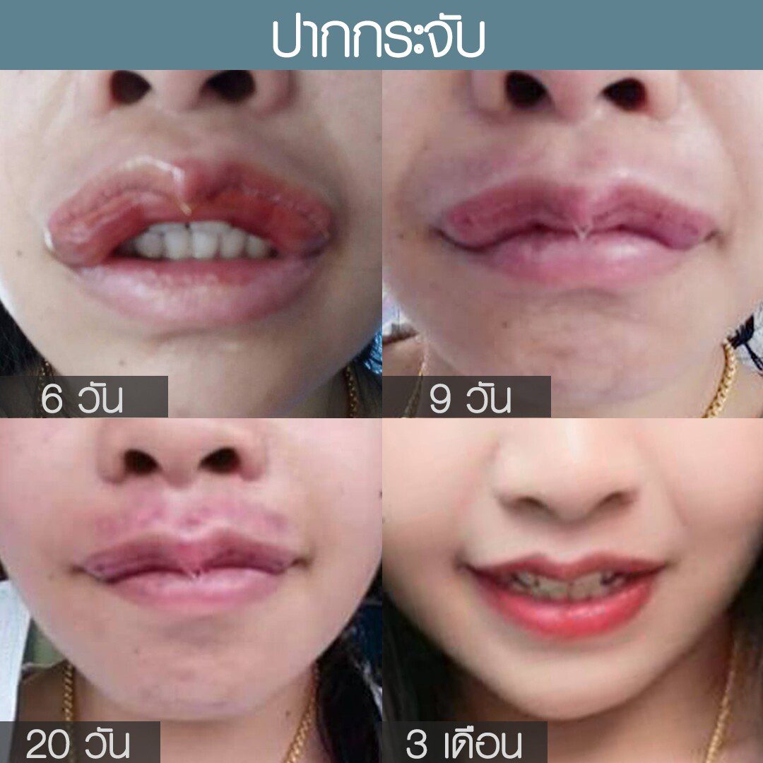 ระยะเวลาเข้าที่หลังทำศัลยกรรม