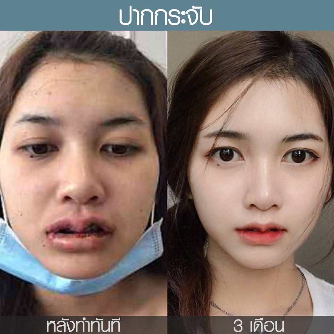 ระยะเวลาเข้าที่หลังทำศัลยกรรม