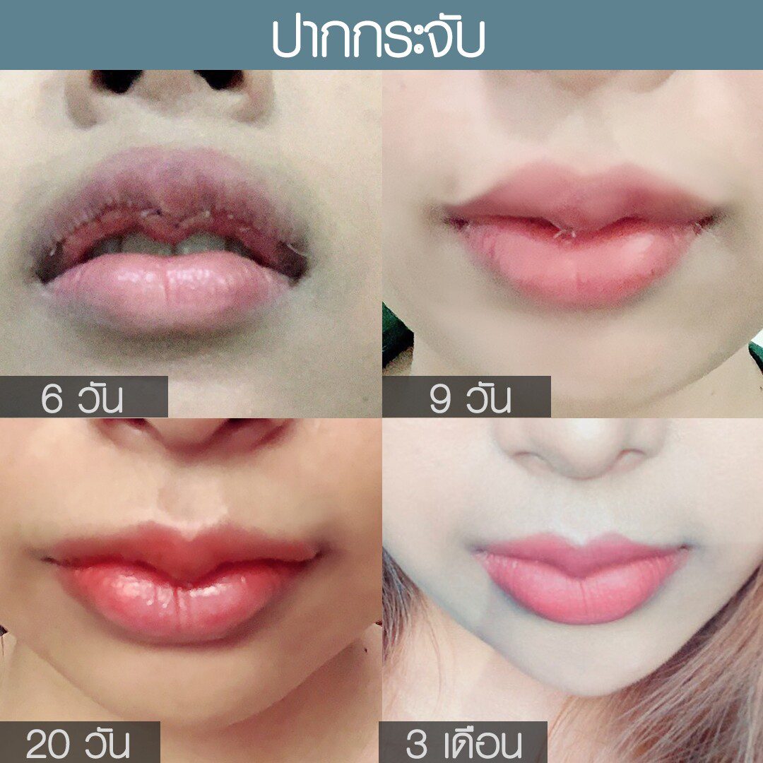 ระยะเวลาเข้าที่หลังทำศัลยกรรม