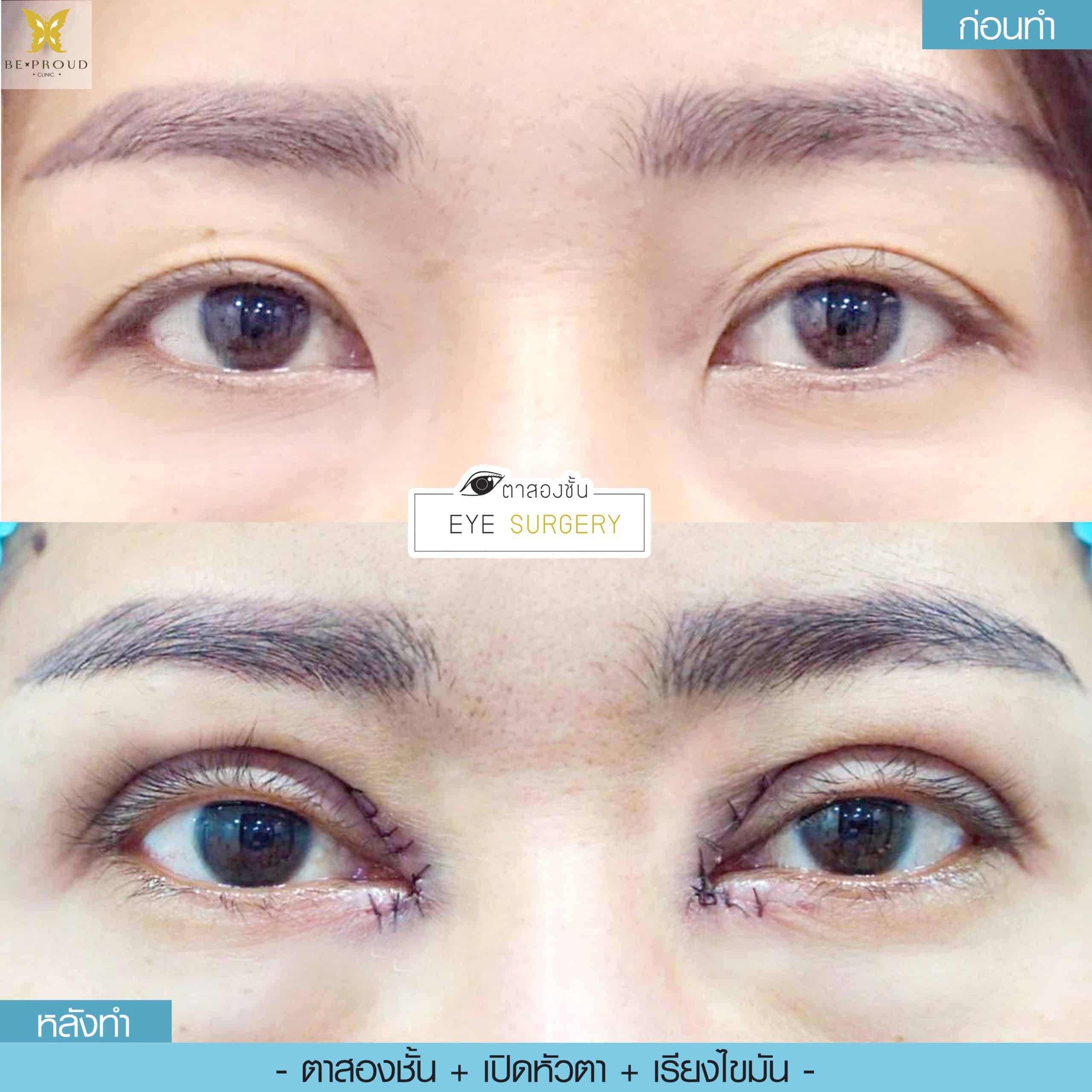 รีวิวตาสองชั้น 59 รีวิวตาสองชั้น 59