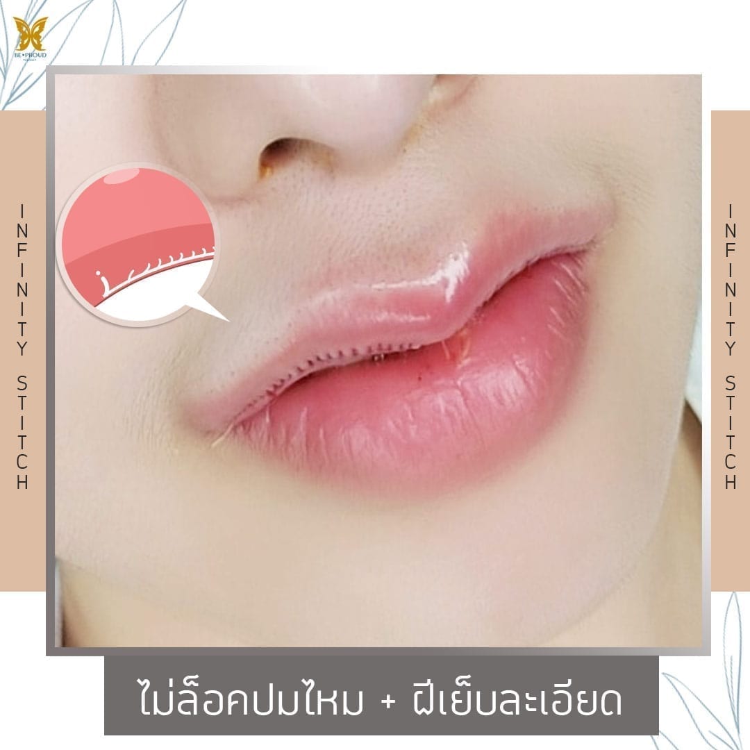 InfinityStitches2 ฝีเย็บละเอียด