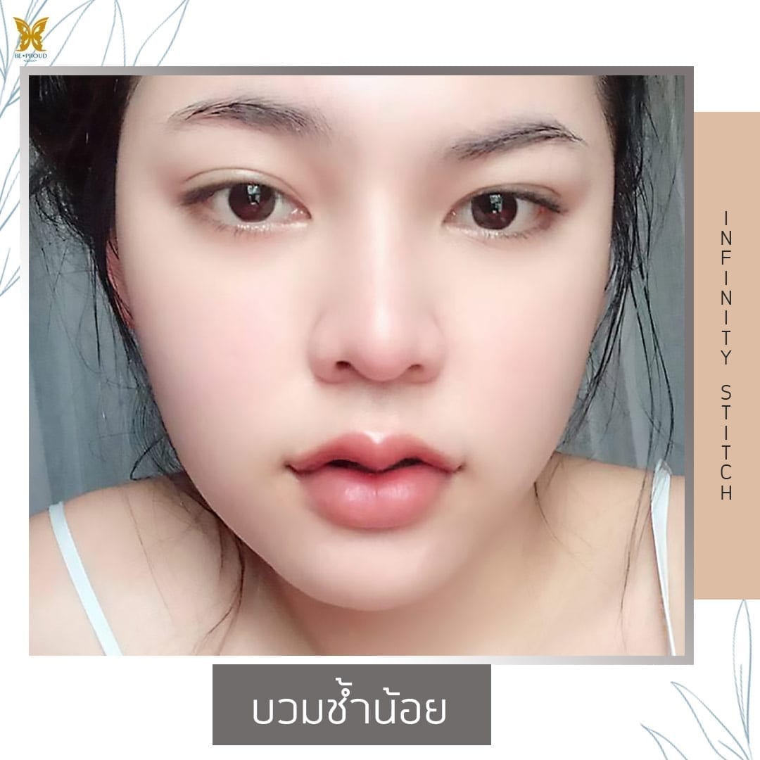 InfinityStitches3 บวมช้ำน้อย