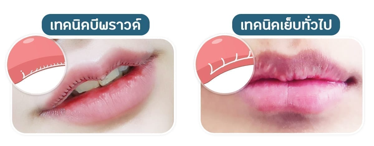 Stitches2 เทคนิคการเย็บแผล