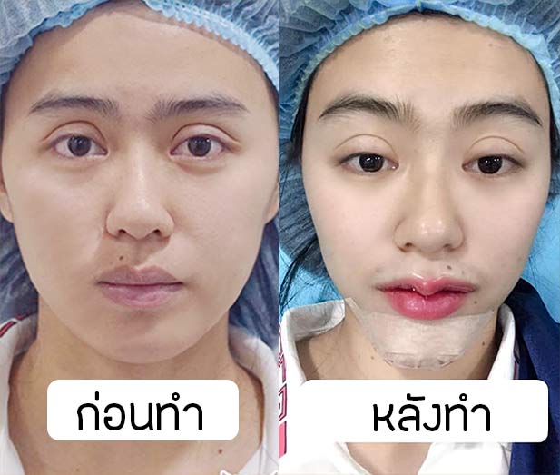 before after ปากคางก่อนหลัง