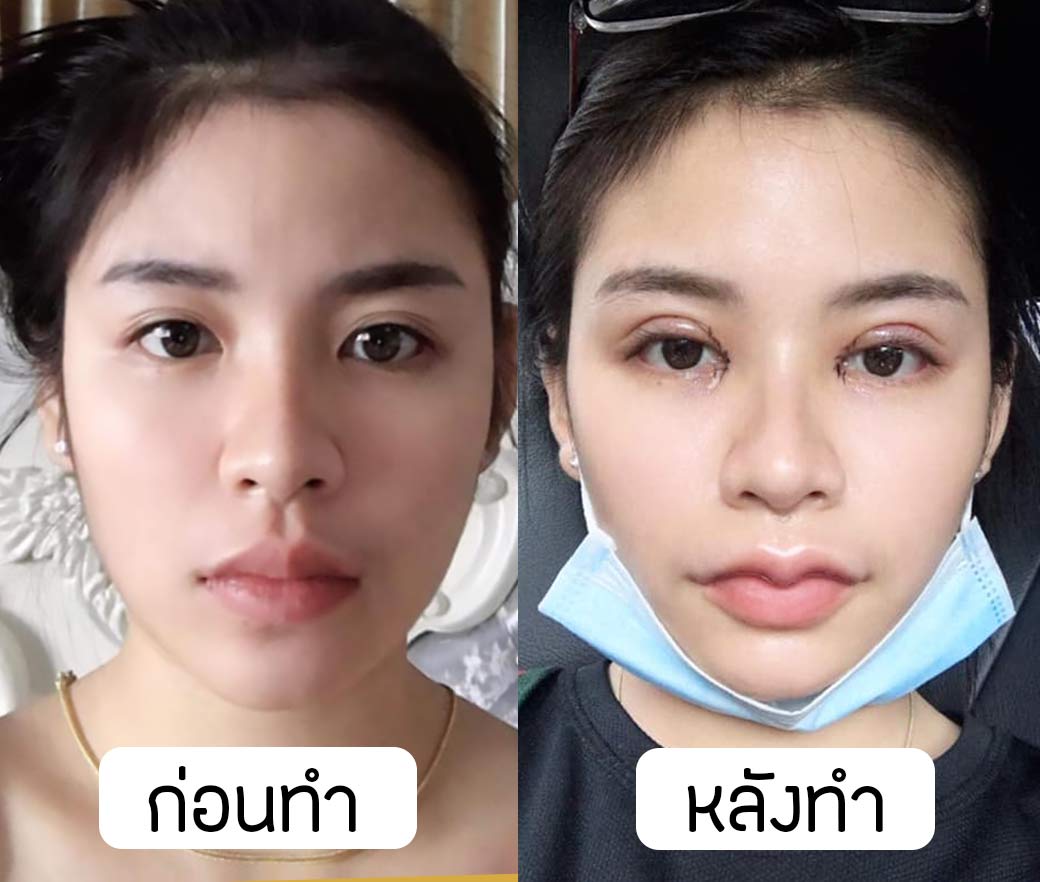 before after ทำตาสองชั้น