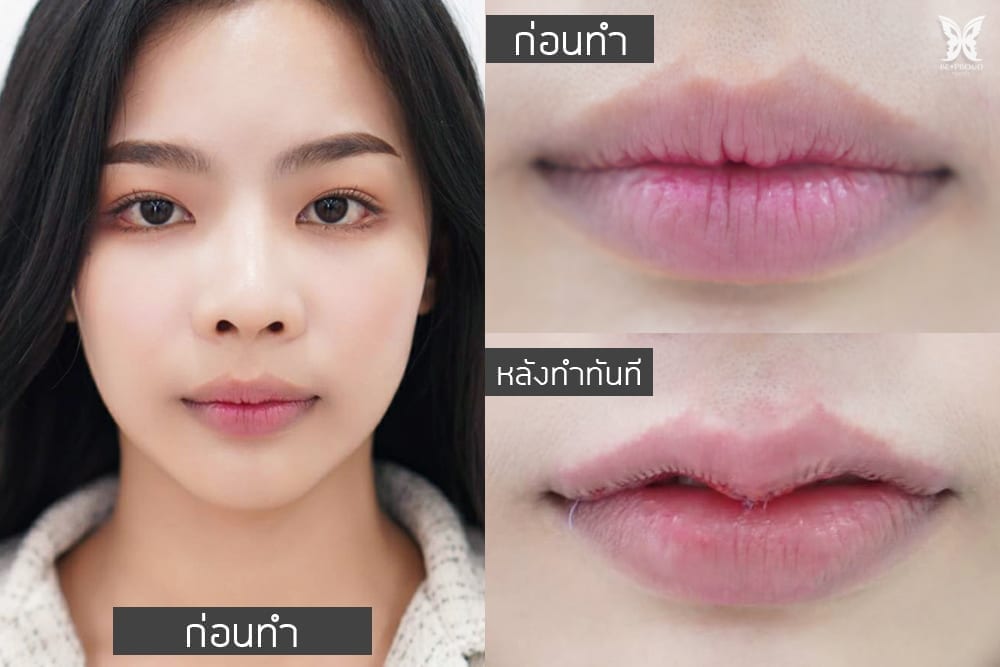before-after ปากกระจับสวยๆ