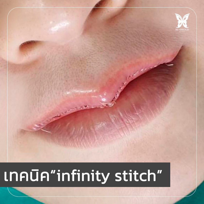 เทคนิคการเย็บ