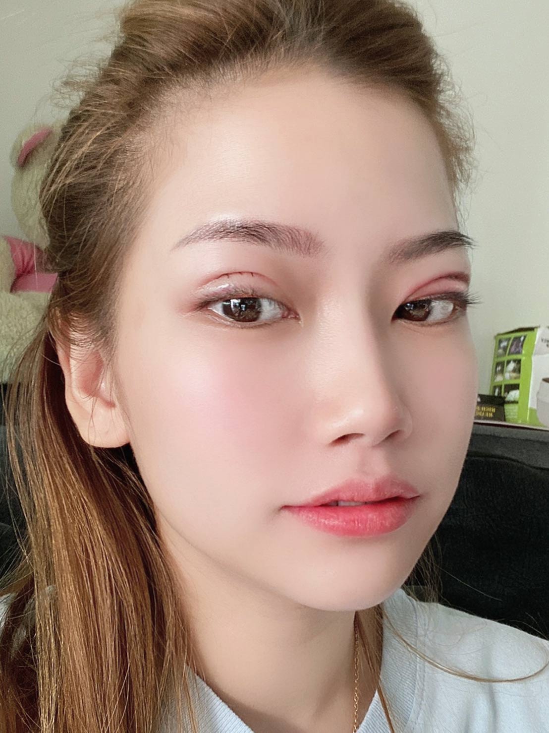 อาการบวมหลังทำตา อาการบวมหลังทำตา