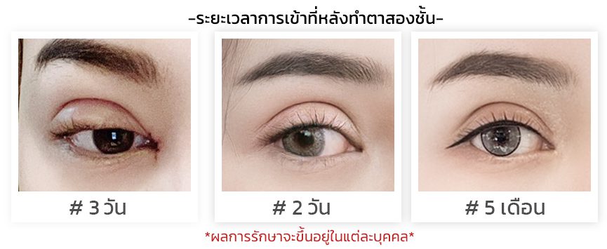 ระยะเวลาเข้าที่ หลังทำตา ระยะเวลาเข้าที่ หลังทำตา